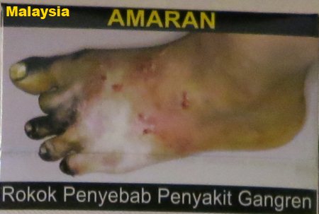 Cigarette Warning (Malaysia): foot gangrene